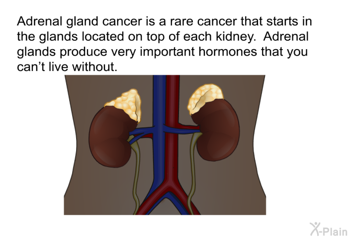 Adrenal gland cancer is a rare cancer that starts in the glands located on top of each kidney. Adrenal glands produce very important hormones that you can't live without.