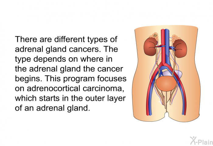 There are different types of adrenal gland cancers. The type depends on where in the adrenal gland the cancer begins. This program focuses on adrenocortical carcinoma, which starts in the outer layer of an adrenal gland.