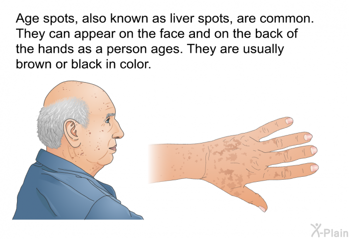 Age spots, also known as liver spots, are common. They can appear on the face and on the back of the hands as a person ages. They are usually brown or black in color.