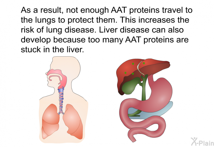 As a result, not enough AAT proteins travel to the lungs to protect them. This increases the risk of lung disease. Liver disease can also develop because too many AAT proteins are stuck in the liver.