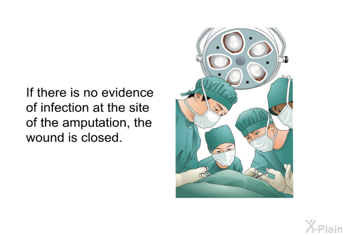 If there is no evidence of infection at the site of the amputation, the wound is closed.