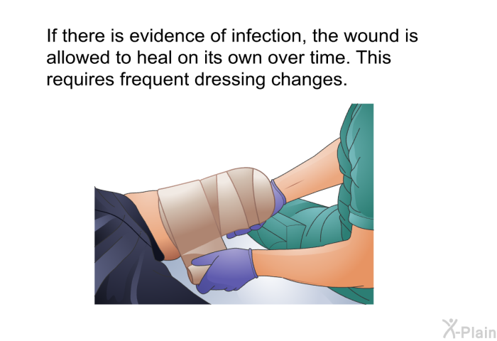 If there is evidence of infection, the wound is allowed to heal on its own over time. This requires frequent dressing changes.
