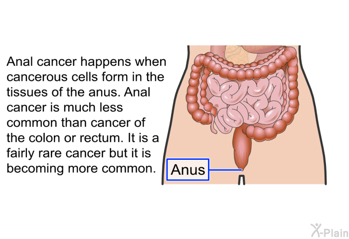 Anal cancer happens when cancerous cells form in the tissues of the anus. Anal cancer is much less common than cancer of the colon or rectum. It is a fairly rare cancer but it is becoming more common.