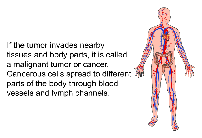 If the tumor invades nearby tissues and body parts, it is called a malignant tumor or cancer. Cancerous cells spread to different parts of the body through blood vessels and lymph channels.