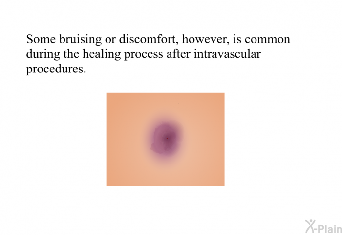 Some bruising or discomfort, however, is common during the healing process after intravascular procedures.