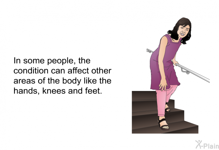 In some people, the condition can affect other areas of the body like the hands, knees and feet.