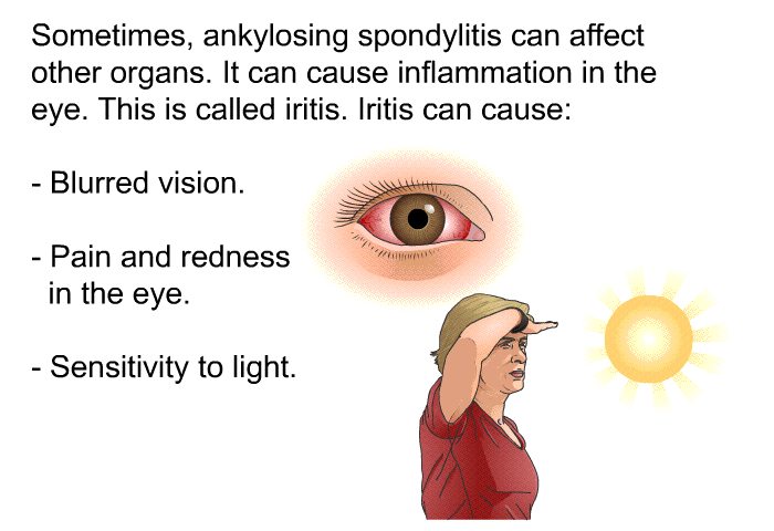 Sometimes, ankylosing spondylitis can affect other organs. It can cause inflammation in the eye. This is called iritis. Iritis can cause:  Blurred vision. Pain and redness in the eye. Sensitivity to light.