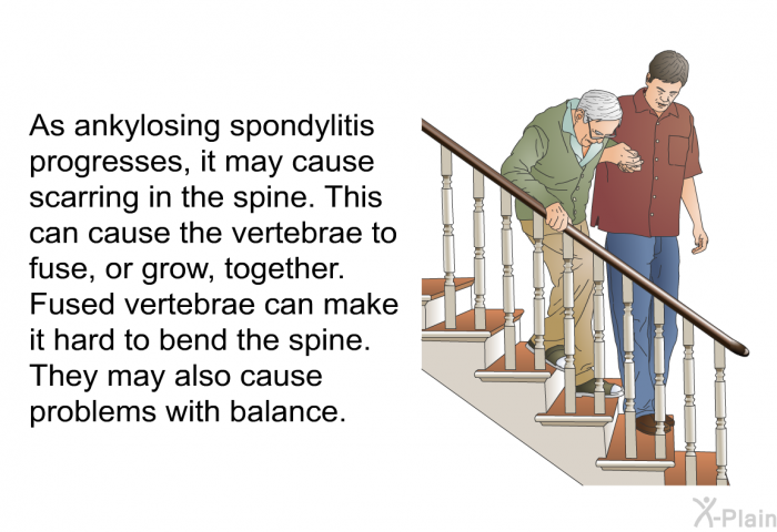 As ankylosing spondylitis progresses, it may cause scarring in the spine. This can cause the vertebrae to fuse, or grow, together. Fused vertebrae can make it hard to bend the spine. They may also cause problems with balance.