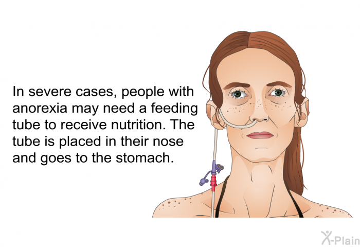 In severe cases, people with anorexia may need a feeding tube to receive nutrition. The tube is placed in their nose and goes to the stomach.