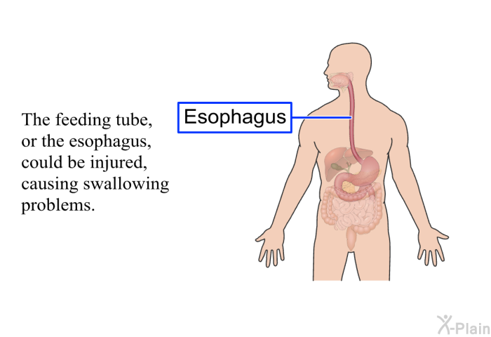The feeding tube, or the esopha­gus, could be injured, causing swallowing problems.