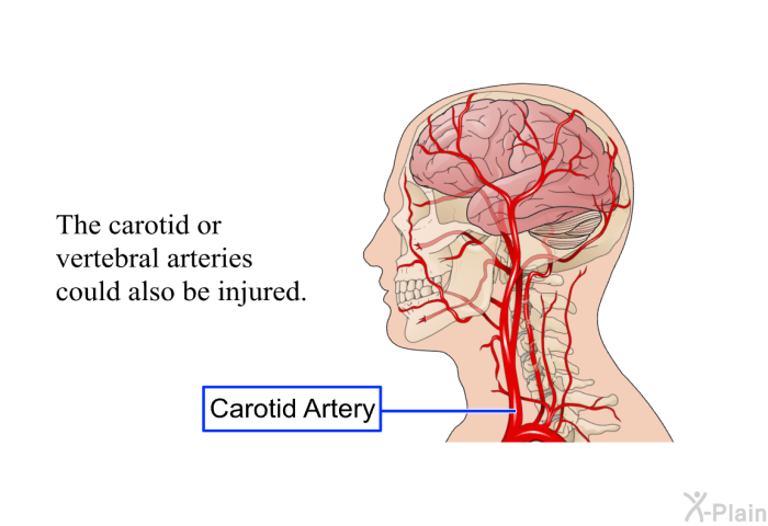 The carotid or vertebral arteries could also be injured.