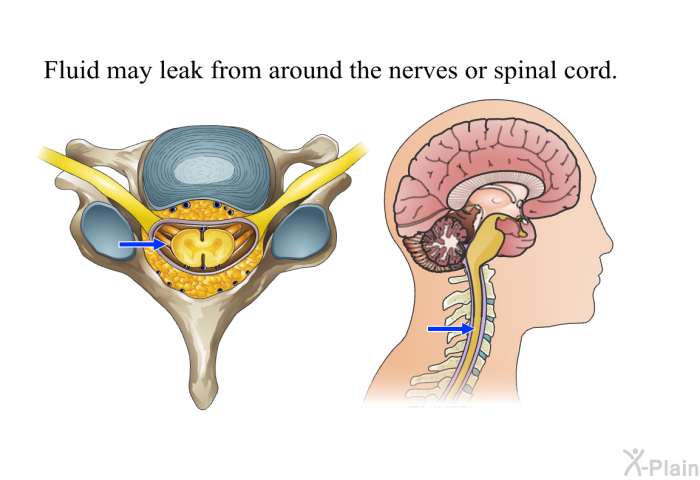 Fluid may leak from around the nerves or spinal cord.