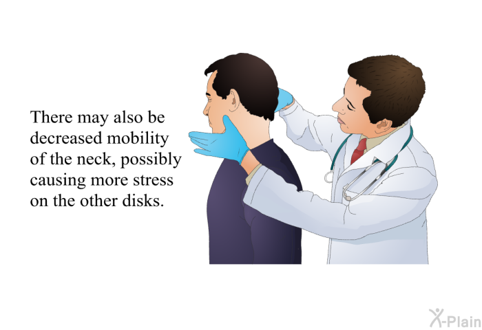 There may also be decreased mobility of the neck, possibly causing more stress on the other disks.