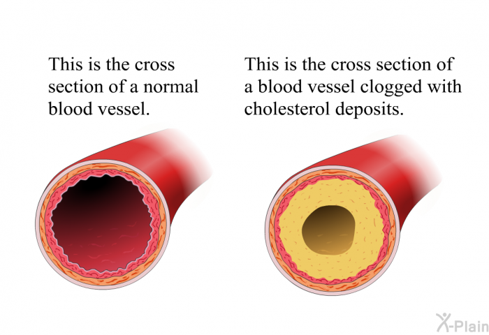 This is the cross section of a normal blood vessel. This is the cross section of a blood vessel clogged with cholesterol deposits.