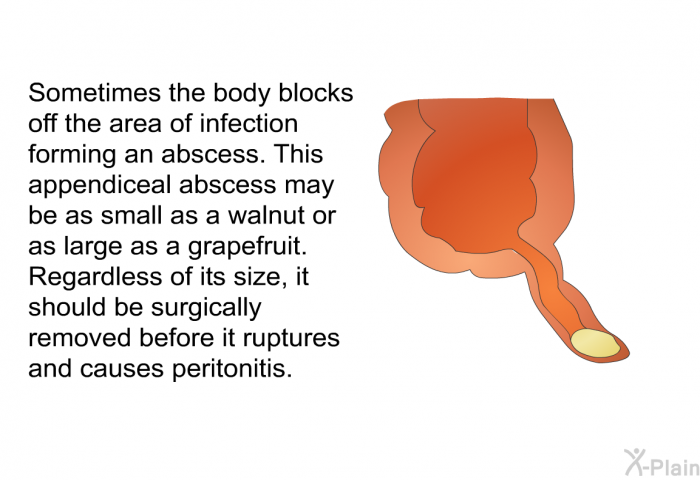 Sometimes the body blocks off the area of infection forming an abscess. This appendiceal abscess may be as small as a walnut or as large as a grapefruit. Regardless of its size, it should be surgically removed before it ruptures and causes peritonitis.