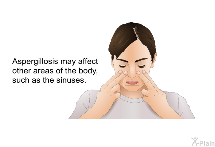 Aspergillosis may affect other areas of the body, such as the sinuses.