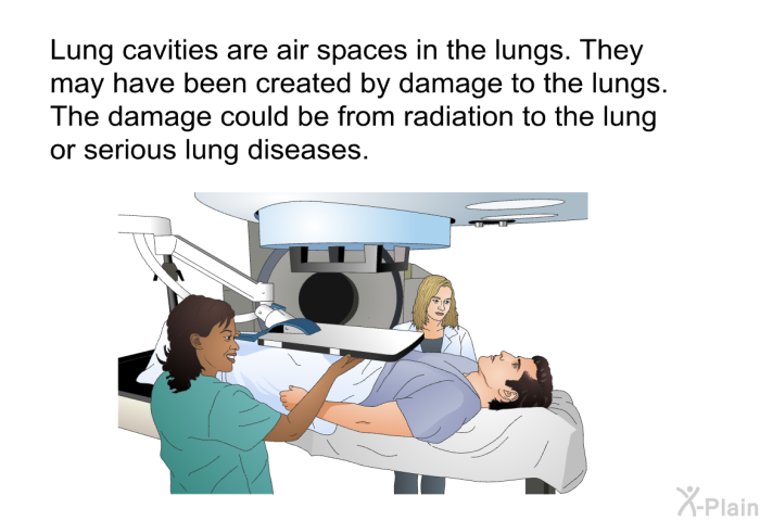 Lung cavities are air spaces in the lungs. They may have been created by damage to the lungs. The damage could be from radiation to the lung or serious lung diseases.