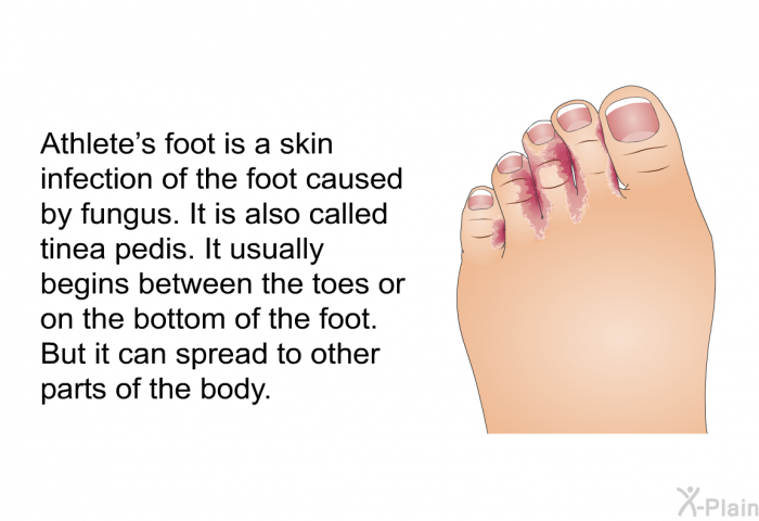 Athlete's foot is a skin infection of the foot caused by fungus. It is also called tinea pedis. It usually begins between the toes or on the bottom of the foot. But it can spread to other parts of the body.