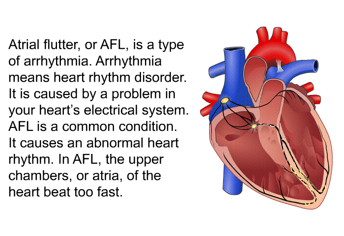 Atrial flutter, or AFL, is a type of arrhythmia. Arrhythmia means heart rhythm disorder. It is caused by a problem in your heart's electrical system. AFL is a common condition. It causes an abnormal heart rhythm. In AFL, the upper chambers, or atria, of the heart beat too fast.