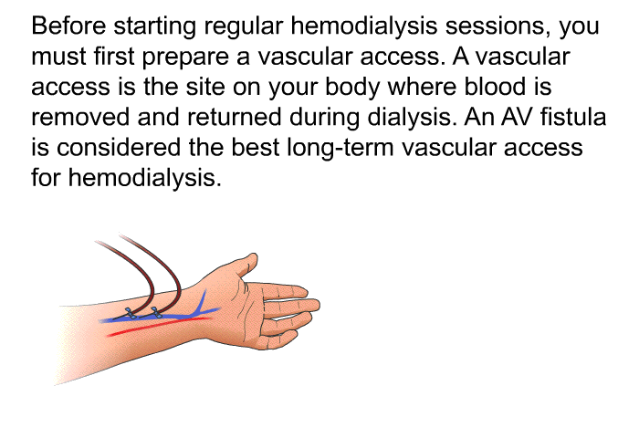 Before starting regular hemodialysis sessions, you must first prepare a vascular access. A vascular access is the site on your body where blood is removed and returned during dialysis. An AV fistula is considered the best long-term vascular access for hemodialysis.