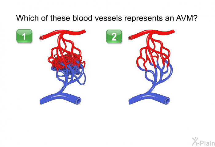 Which of these blood vessels represents an AVM?