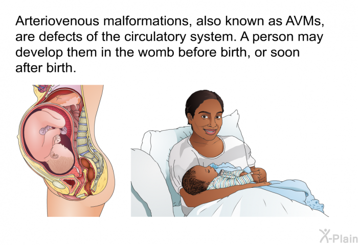 Arteriovenous malformations, also known as AVMs, are defects of the circulatory system. A person may develop them in the womb before birth, or soon after birth.