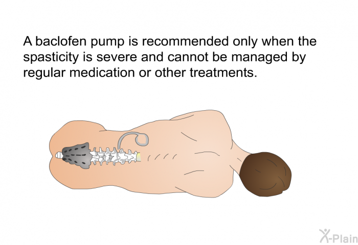 A baclofen pump is recommended only when the spasticity is severe and cannot be managed by regular medication or other treatments.