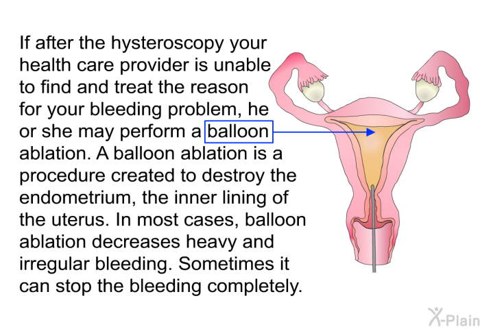 If after the hysteroscopy your health care provider is unable to find and treat the reason for your bleeding problem, he or she may perform a balloon ablation. A balloon ablation is a procedure created to destroy the endometrium, the inner lining of the uterus. In most cases, balloon ablation decreases heavy and irregular bleeding. Sometimes it can stop the bleeding completely.