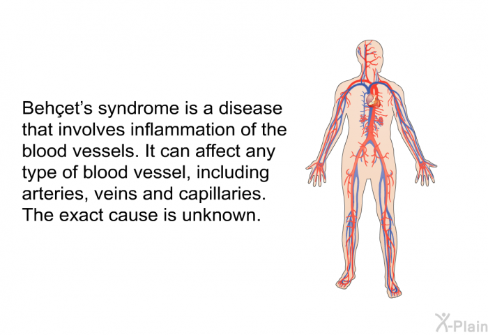 Behçet's syndrome is a disease that involves inflammation of the blood vessels. It can affect any type of blood vessel, including arteries, veins and capillaries. The exact cause is unknown.