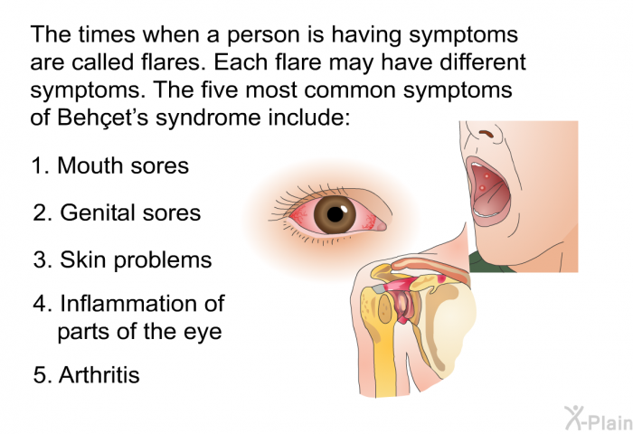 The times when a person is having symptoms are called flares. Each flare may have different symptoms. The five most common symptoms of Behçet's syndrome include:  Mouth sores Genital sores Skin problems Inflammation of parts of the eye Arthritis