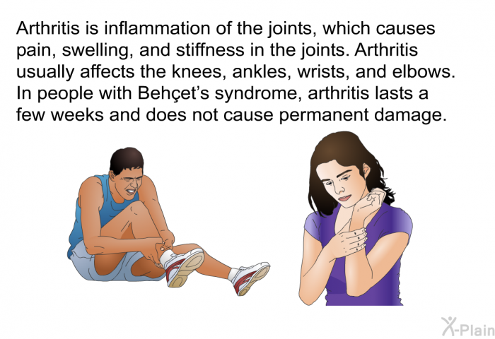 Arthritis is inflammation of the joints, which causes pain, swelling, and stiffness in the joints. Arthritis usually affects the knees, ankles, wrists, and elbows. In people with Behçet's syndrome, arthritis lasts a few weeks and does not cause permanent damage.