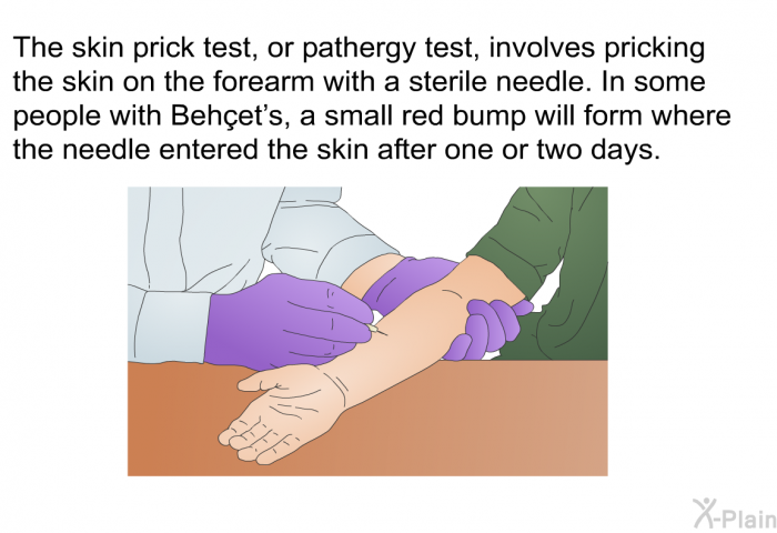 The skin prick test, or pathergy test, involves pricking the skin on the forearm with a sterile needle. In some people with Behet’s, a small red bump will form where the needle entered the skin after one or two days.