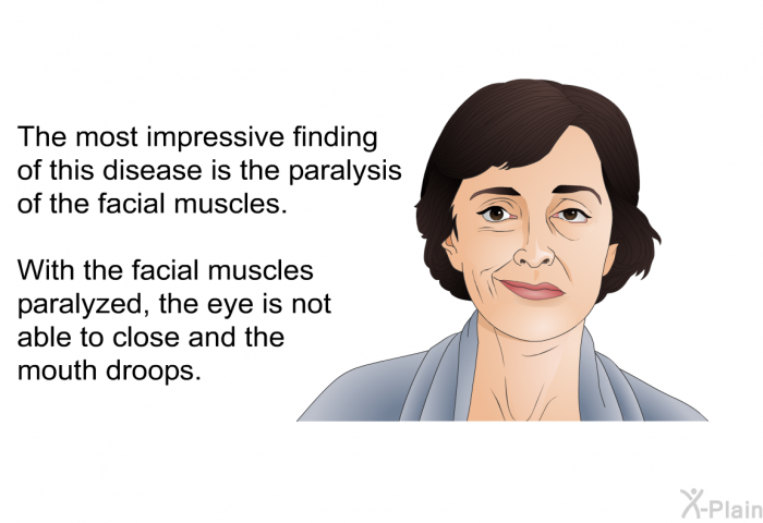 The most impressive finding of this disease is the paralysis of the facial muscles. With the facial muscles paralyzed, the eye is not able to close and the mouth droops.