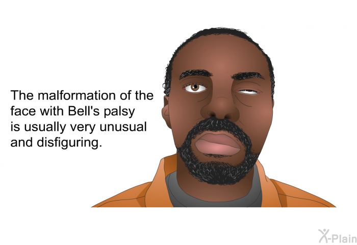 The malformation of the face with Bell's palsy is usually very unusual and disfiguring.