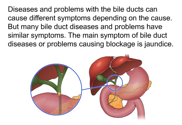 Diseases and problems with the bile ducts can cause different symptoms depending on the cause. But many bile duct diseases and problems have similar symptoms. The main symptom of bile duct diseases or problems causing blockage is jaundice.