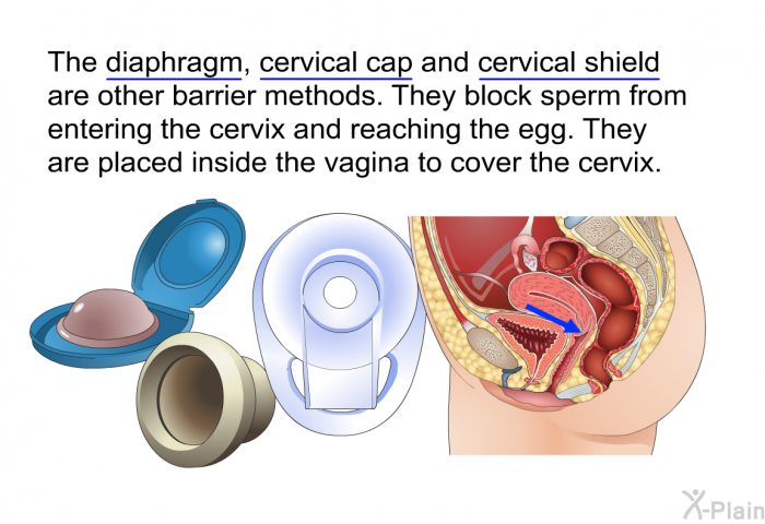 The diaphragm, cervical cap and cervical shield are other barrier methods. They block sperm from entering the cervix and reaching the egg. They are placed inside the vagina to cover the cervix.
