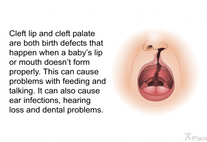 Cleft lip and cleft palate are both birth defects that happen when a baby's lip or mouth doesn't form properly. This can cause problems with feeding and talking. It can also cause ear infections, hearing loss and dental problems.