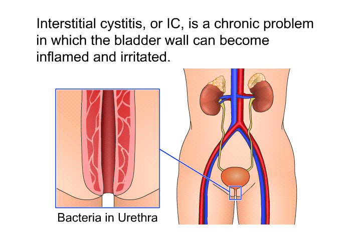 Interstitial cystitis, or IC, is a chronic problem in which the bladder wall can become inflamed and irritated.