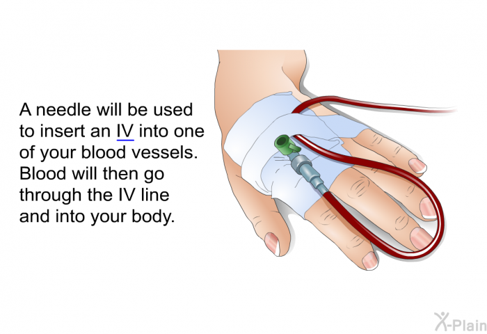 A needle will be used to insert an IV into one of your blood vessels. Blood will then go through the IV line and into your body.