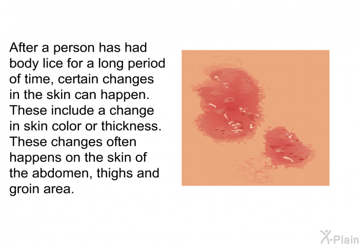 After a person has had body lice for a long period of time, certain changes in the skin can happen. These include a change in skin color or thickness. These changes often happens on the skin of the abdomen, thighs and groin area.