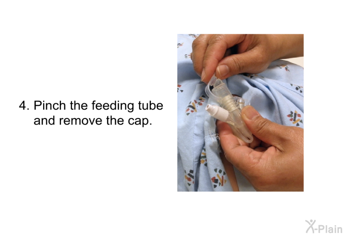 Pinch the feeding tube and remove the cap.