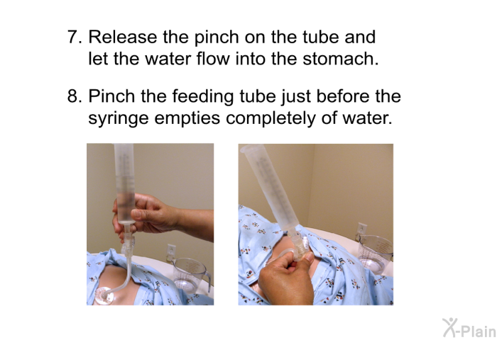 Release the pinch on the tube and let the water flow into the stomach. Pinch the feeding tube just before the syringe empties completely of water.