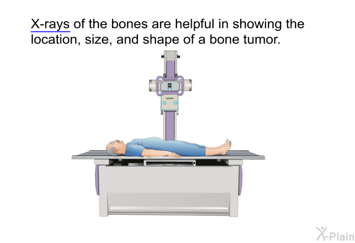 X-rays of the bones are helpful in showing the location, size, and shape of a bone tumor.