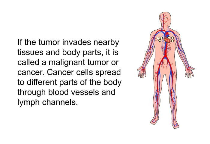 If the tumor invades nearby tissues and body parts, it is called a malignant tumor or cancer. Cancer cells spread to different parts of the body through blood vessels and lymph channels.