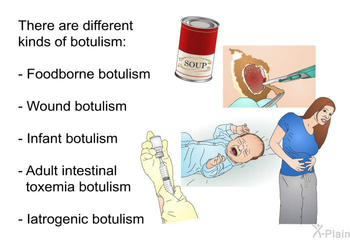 There are different kinds of botulism:  Foodborne botulism Wound botulism Infant botulism Adult intestinal toxemia botulism Iatrogenic botulism