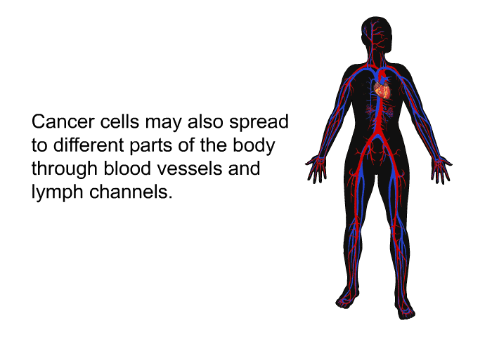 Cancer cells may also spread to different parts of the body through blood vessels and lymph channels.