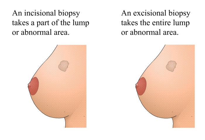 An incisional biopsy takes a part of the lump or abnormal area. An excisional biopsy takes the entire lump or abnormal area.