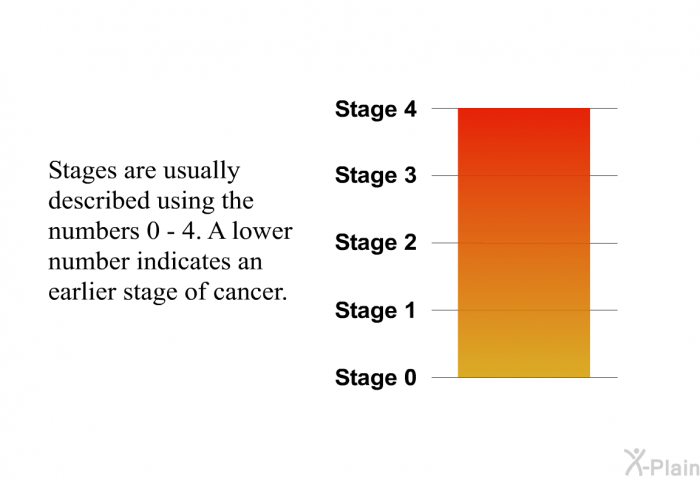 Stages are usually described using the numbers 0 - 4. A lower number indicates an earlier stage of cancer.