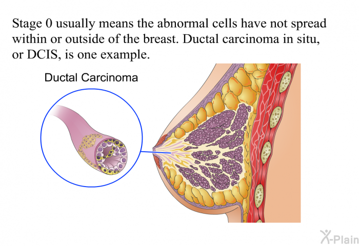 Stage 0 usually means the abnormal cells have not spread within or outside of the breast. Ductal carcinoma in situ, or DCIS, is one example.