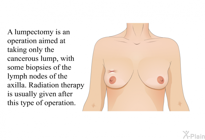 A lumpectomy is an operation aimed at taking only the cancerous lump, with some biopsies of the lymph nodes of the axilla. Radiation therapy is usually given after this type of operation.